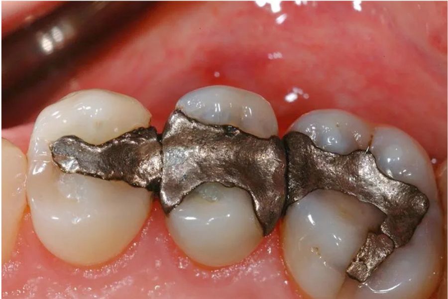Amalgam Fillings