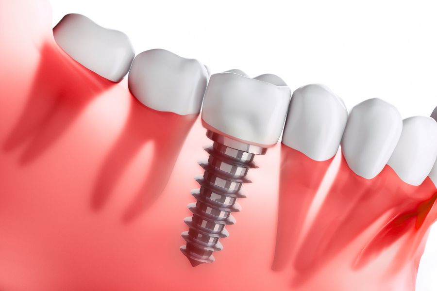 Dental Implant Benefits