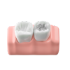 Cavity Filling
