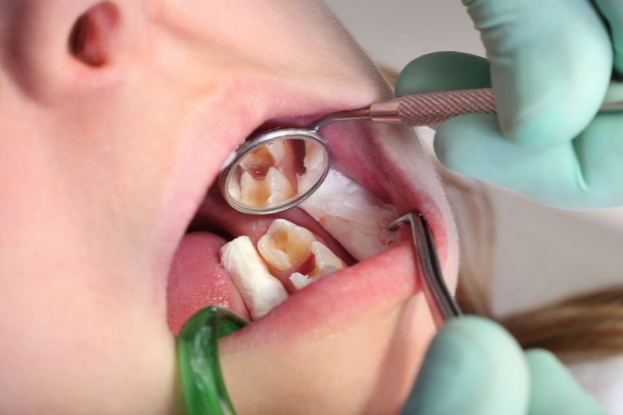 Cavity Filling