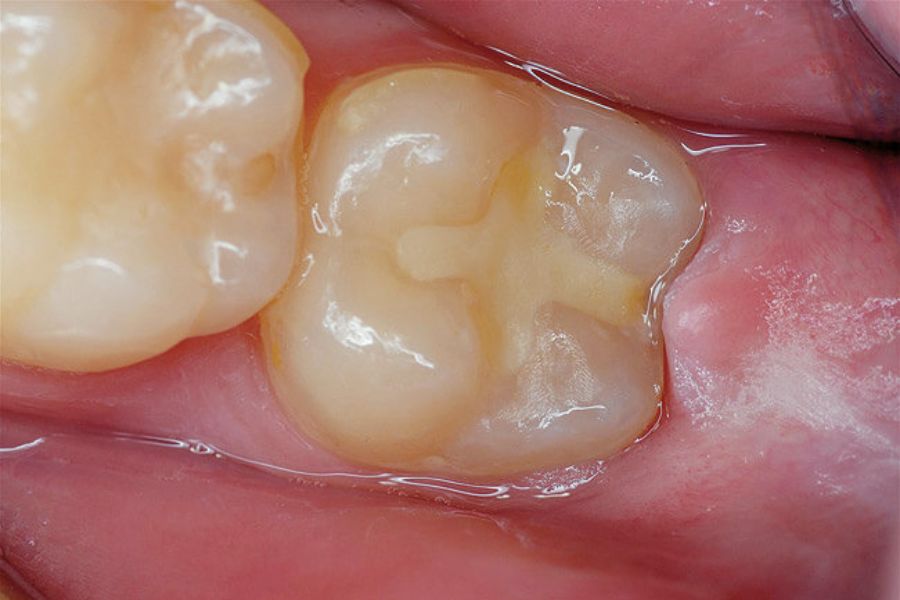 Composite Fillings