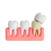 Dental Crowns