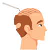 FUT Hair Transplant
