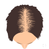 Hairline Restoration