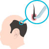 PRP Therapy