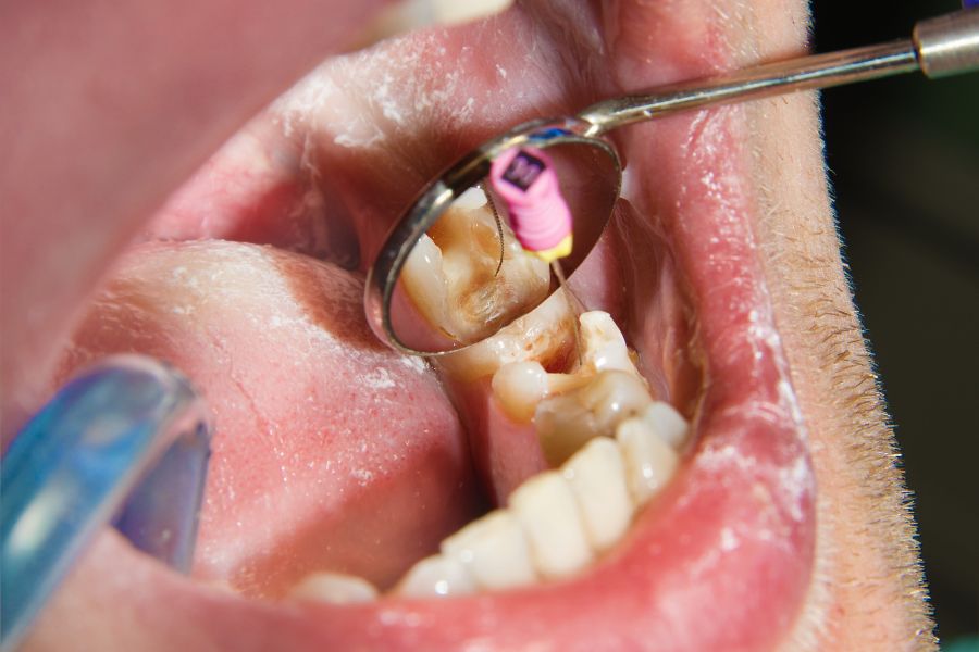 Root Canal Treatment