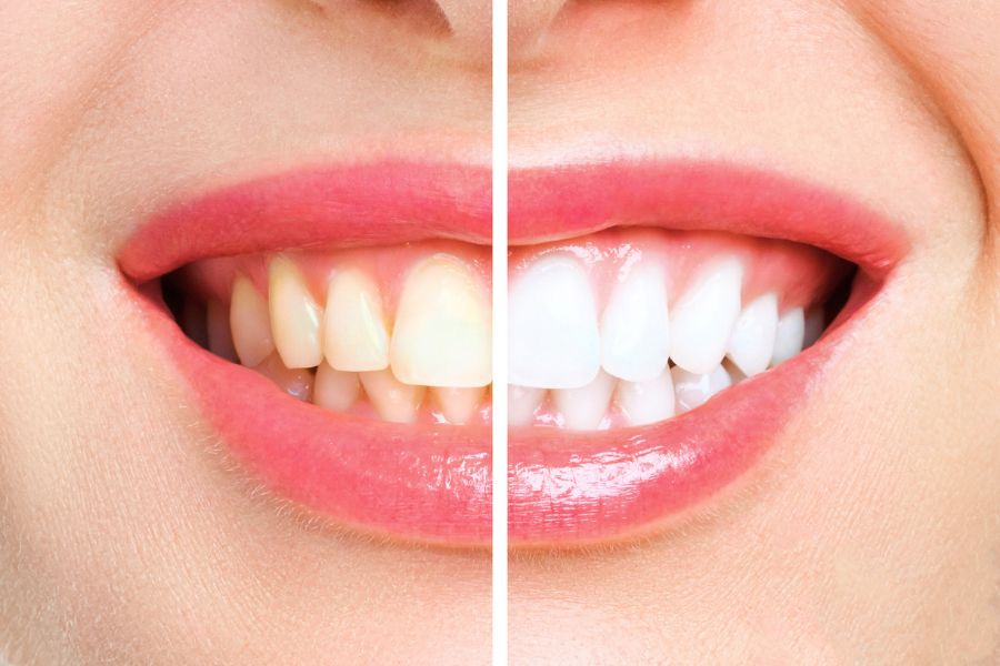 Teeth Whitening Benefits