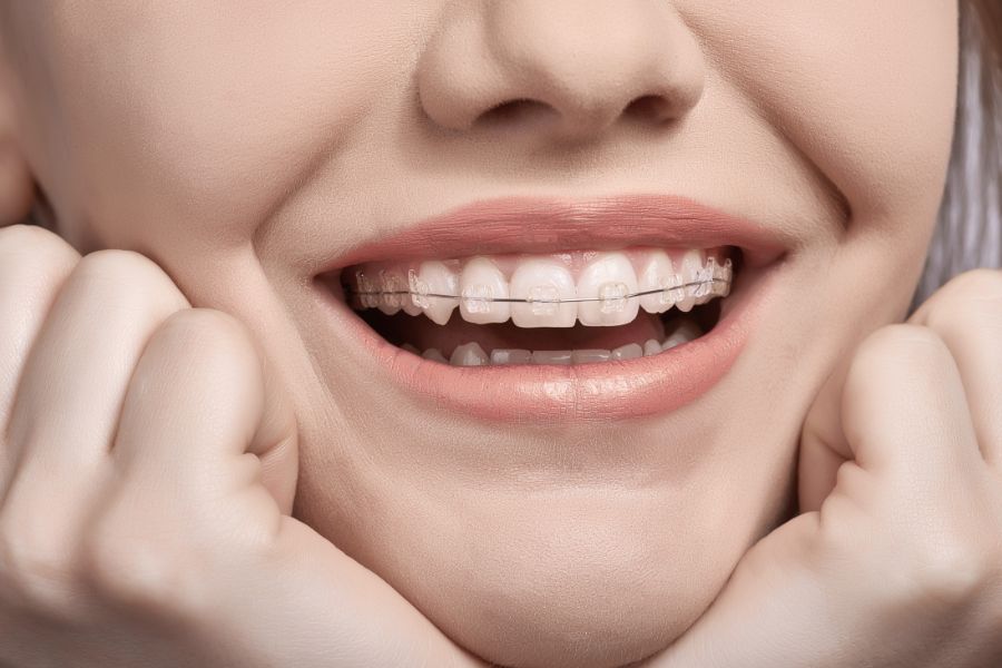 Braces and Aligners Benefits