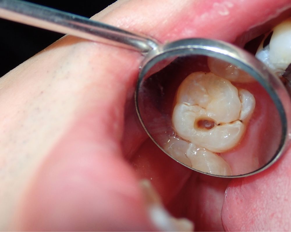Cavity Symptoms