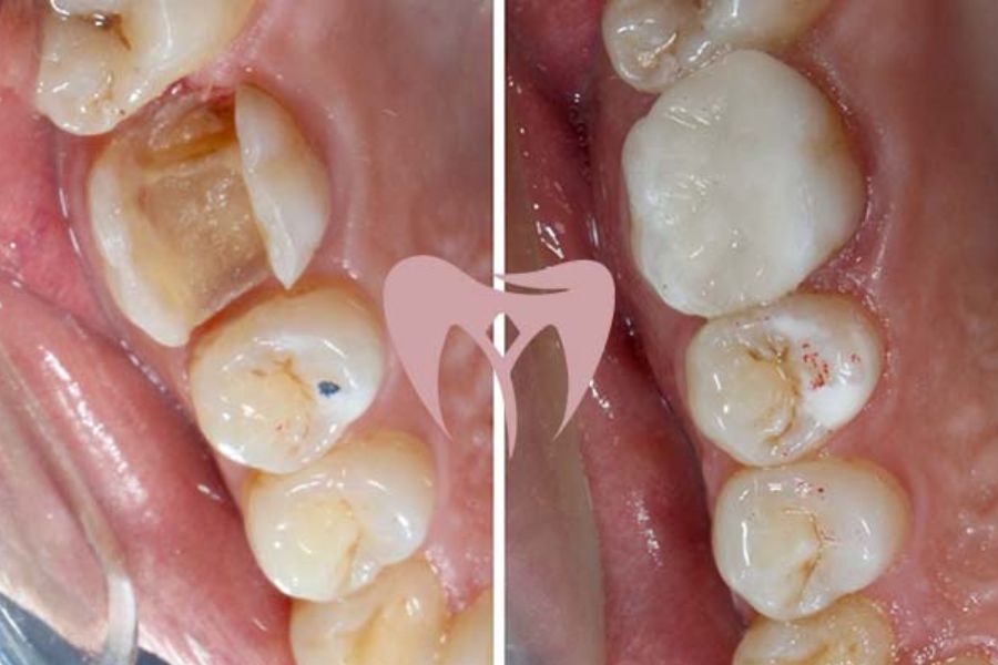 Ceramic Fillings