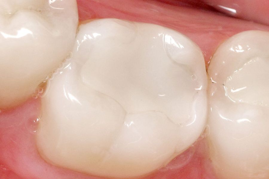 Glass Ionomer Fillings