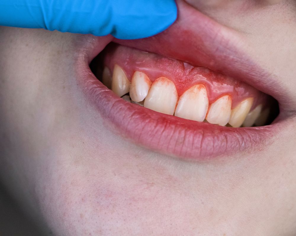 Gum Disease Symptoms
