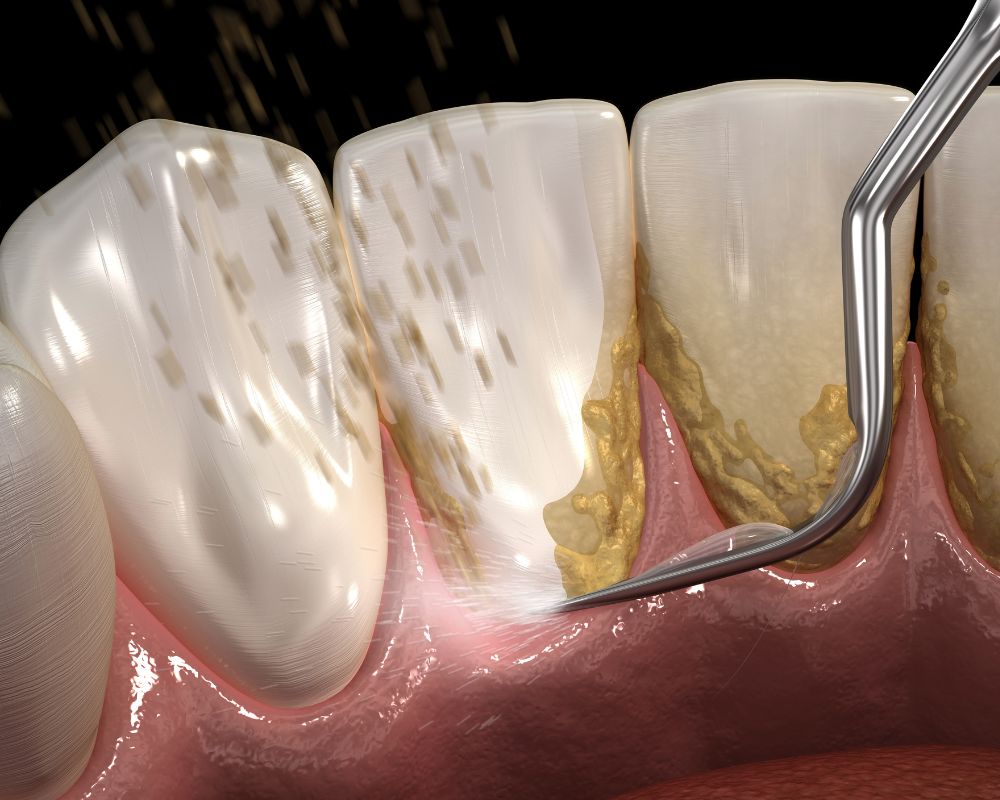 Teeth Cleaning Symptoms