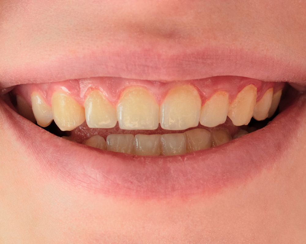 Teeth Whitening Symptoms