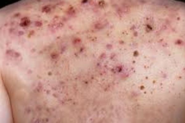Acne Conglobata