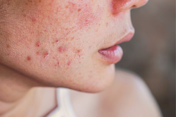Acne Scar Treatment