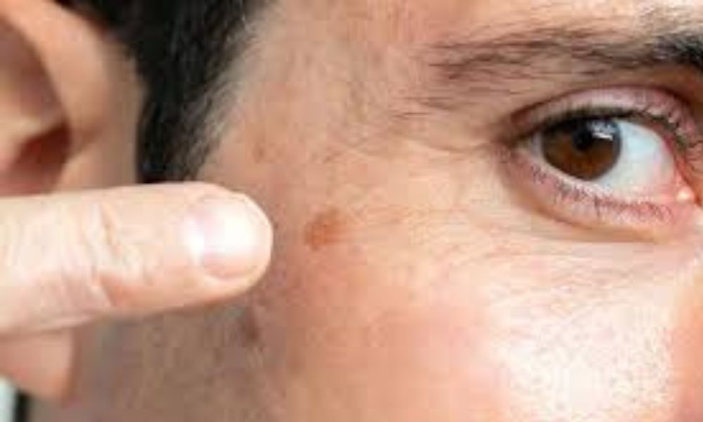 Age Spots