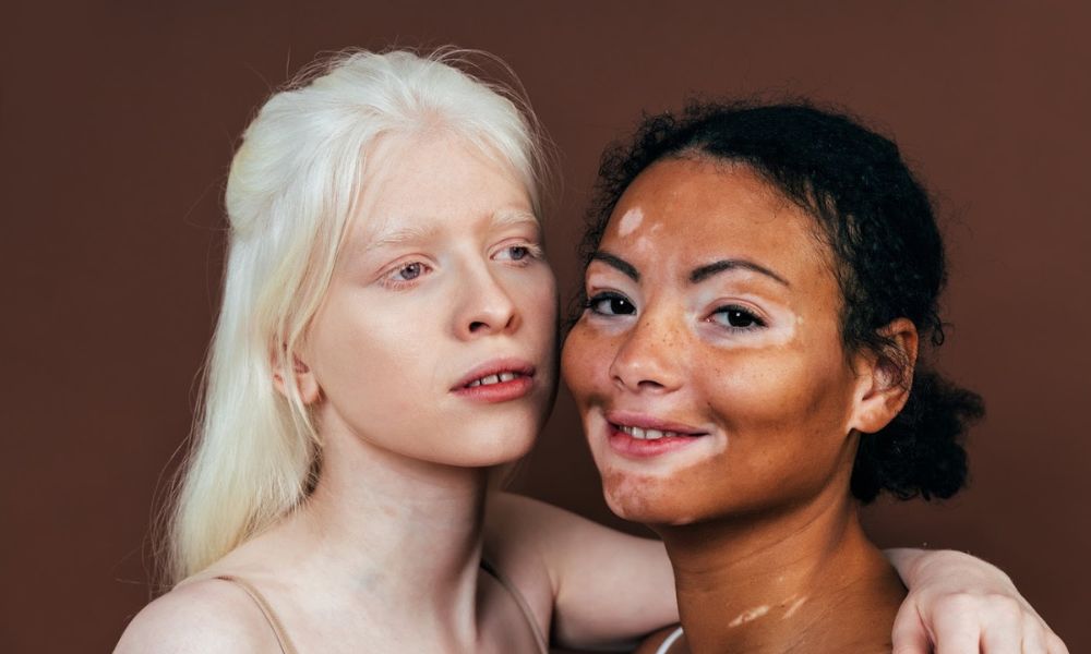 Albinism