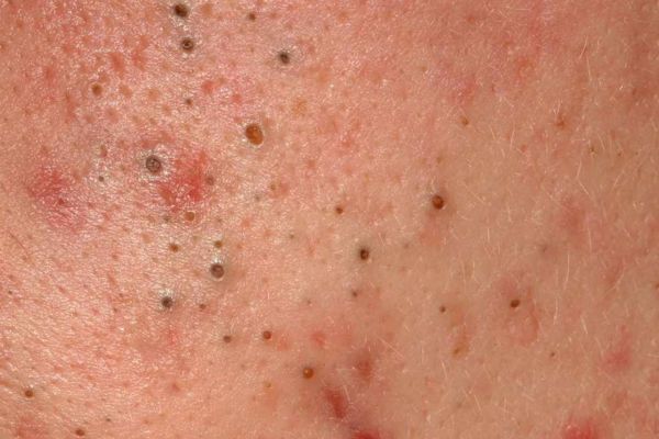 Comedonal Acne