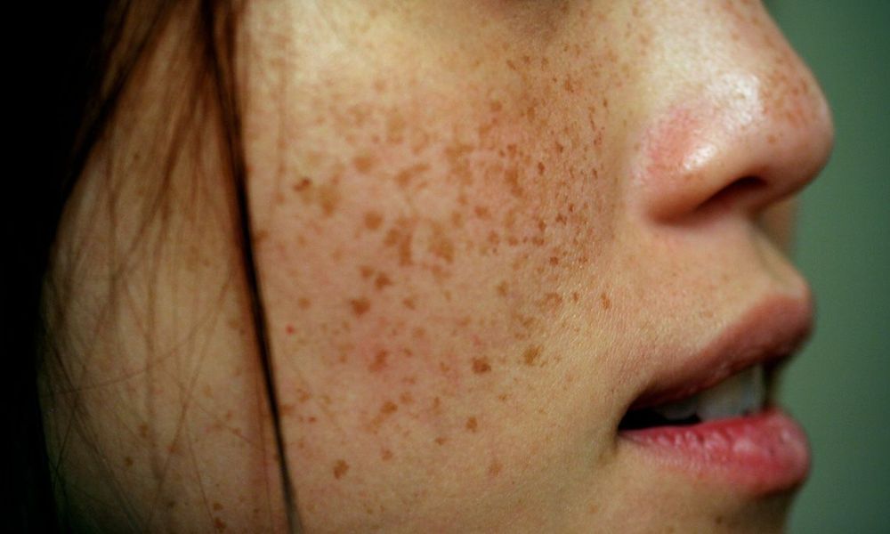 Freckles