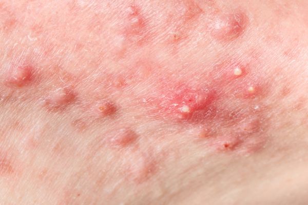 Inflammatory Acne