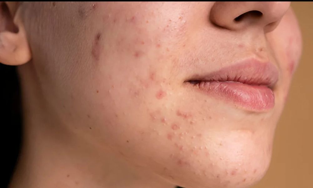 Melasma