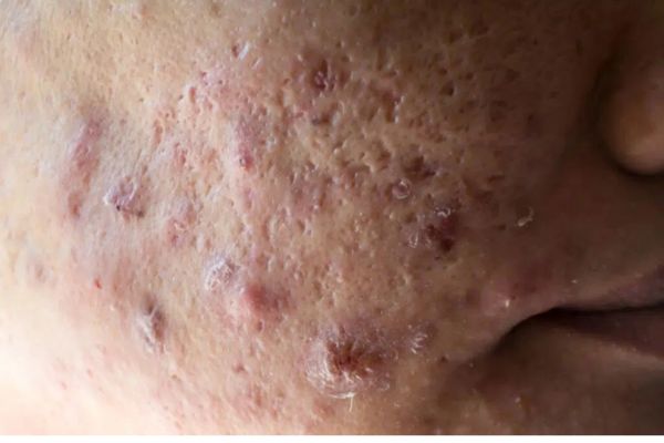 Nodular Acne
