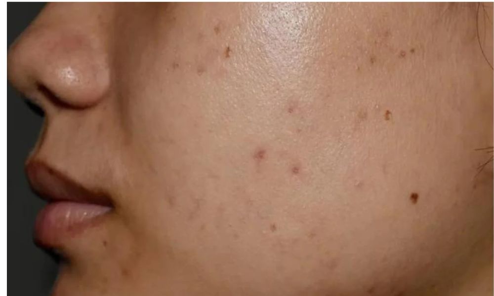 Post-Inflammatory Hyperpigmentation