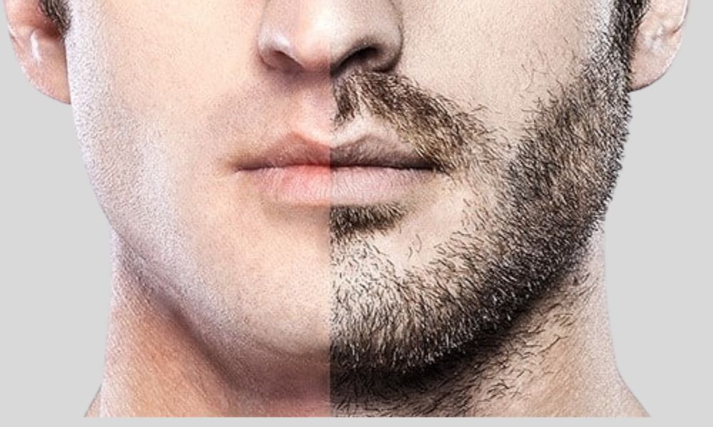 Beard Transplant at Cherian Clinic