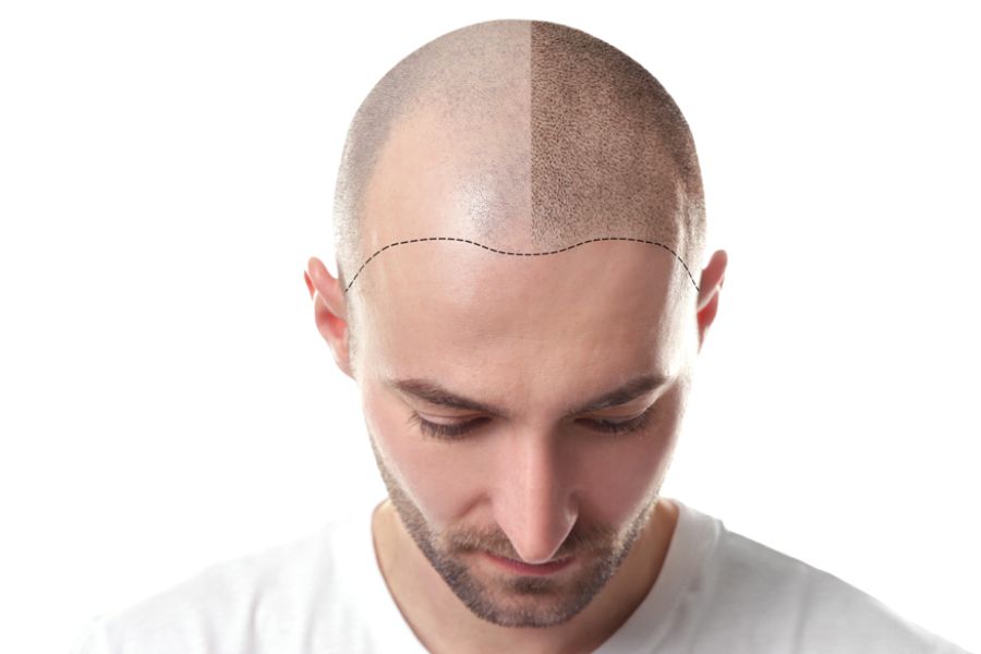 FUE & FUT Techniques