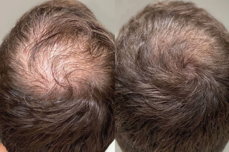 Chronic Musculoskeletal Injuries