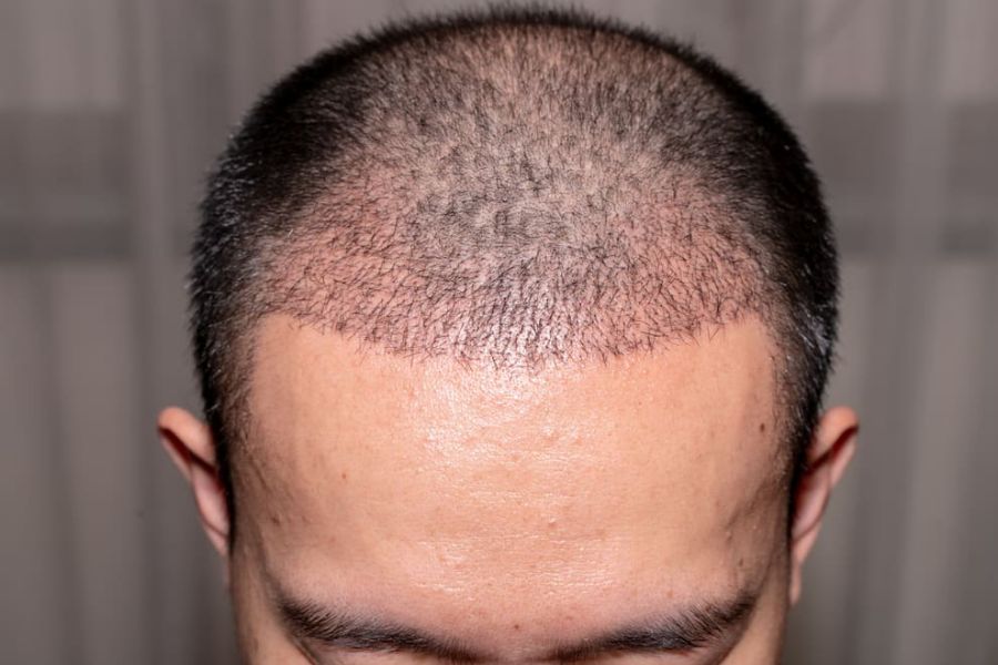 Non-Shaven FUE