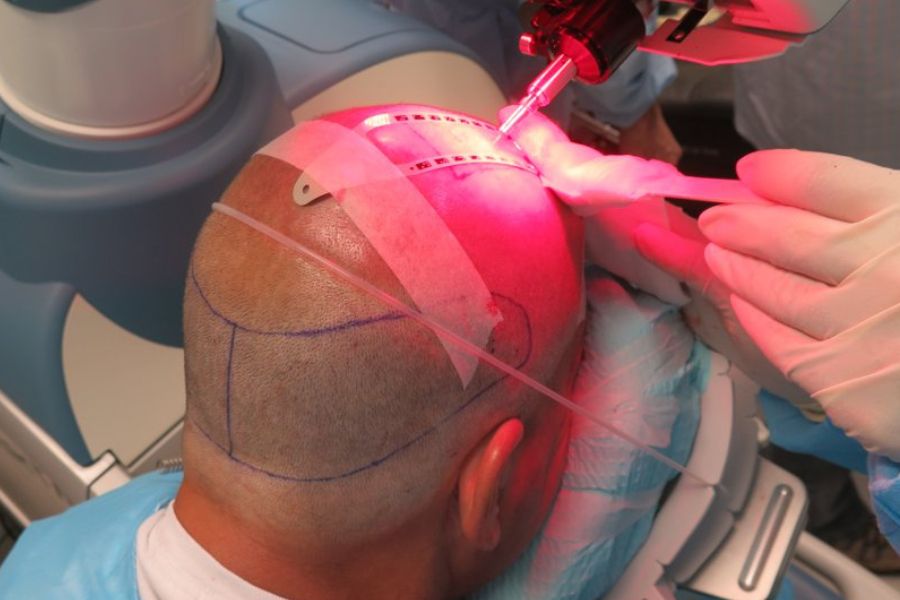Robotic FUE
