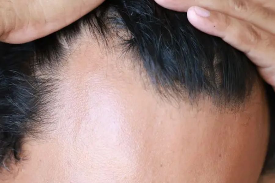 Scarring Alopecia