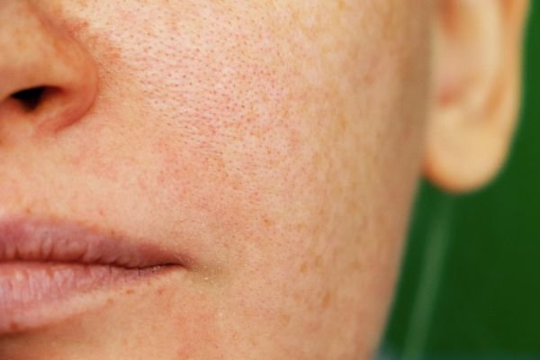 Pigmentation Treatment