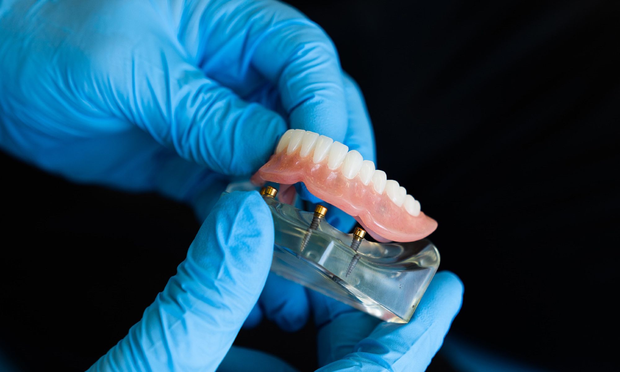 Benefits of Dentures