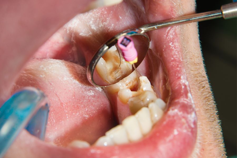 Root Canal Treatment
