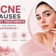 Acne Causes and Best Treatments Available in Varanasi | Cherian Clinic